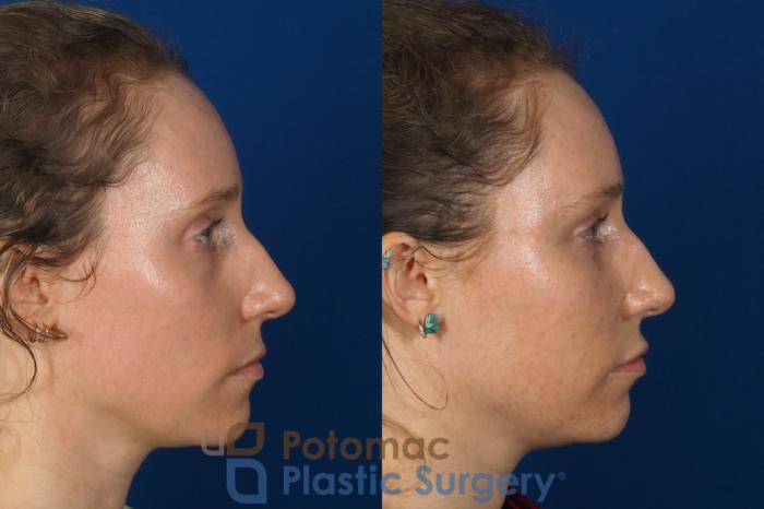 Before & After Blepharoplasty (Eyelid Surgery) Case 316 Right Side View in Washington DC & Arlington , DC