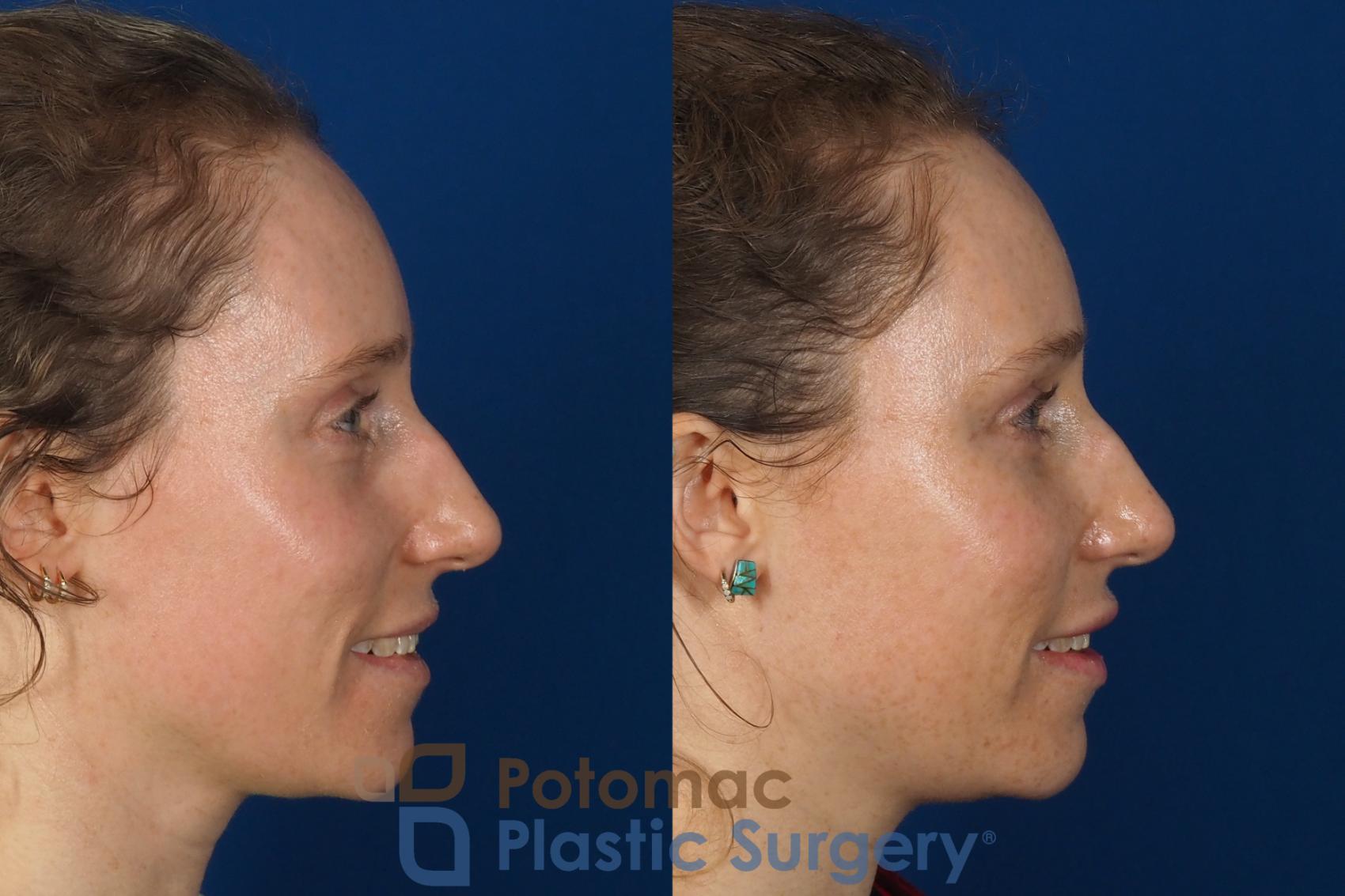 Before & After Facial Sculpting Case 316 Right - Smiling View in Washington DC & Arlington , DC