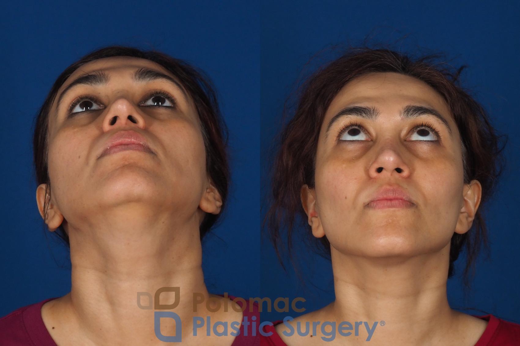 Before & After Fat Transfer Case 358 Bottom View in Washington DC & Arlington , DC