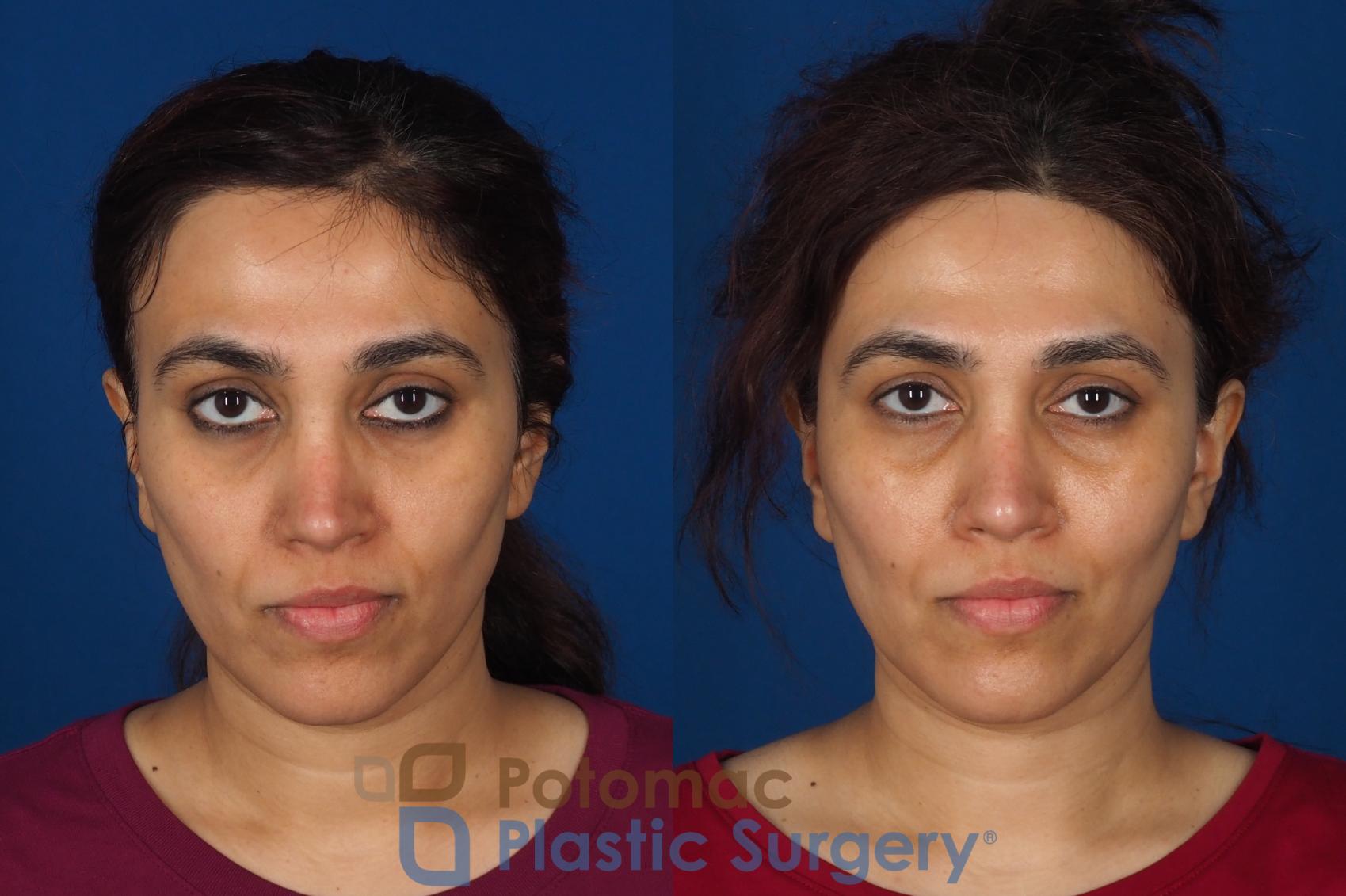 Before & After Fat Transfer Case 358 Front View in Washington DC & Arlington , DC