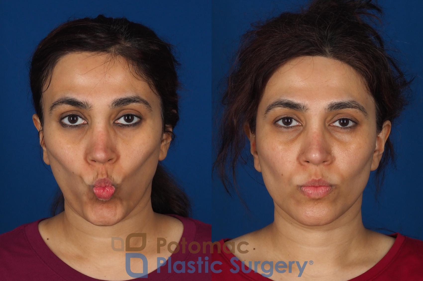 Before & After Fat Transfer Case 358 Front - Puckering View in Washington DC & Arlington , DC