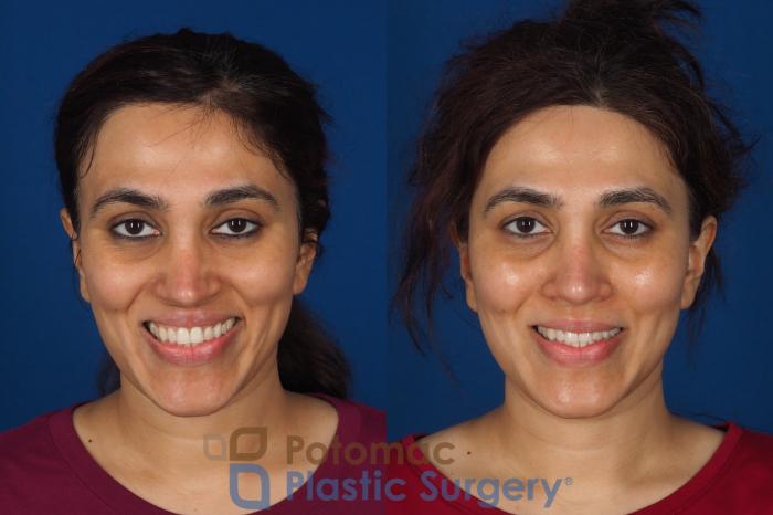 Before & After Fat Transfer Case 358 Front - Smiling View in Washington DC & Arlington , DC