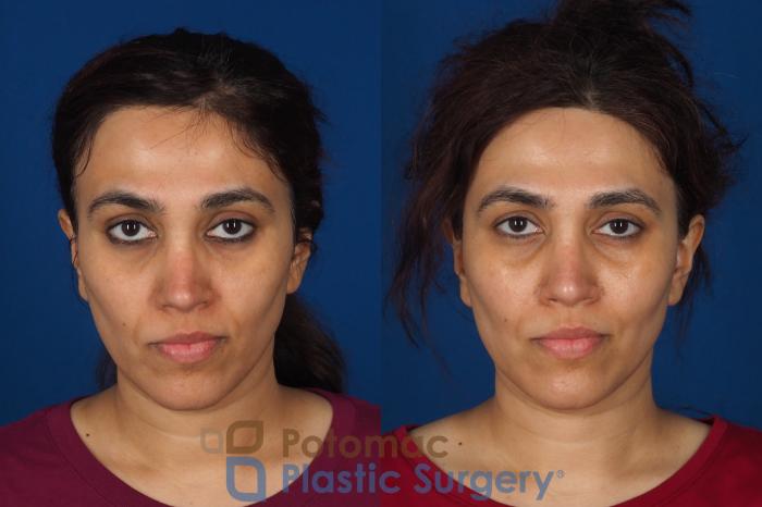 Before & After Fat Transfer Case 358 Front View in Washington DC & Arlington , DC