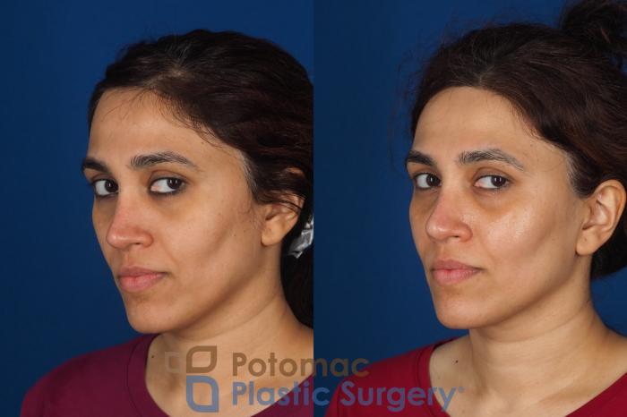 Before & After Fat Transfer Case 358 Left Oblique 2 View in Washington DC & Arlington , DC