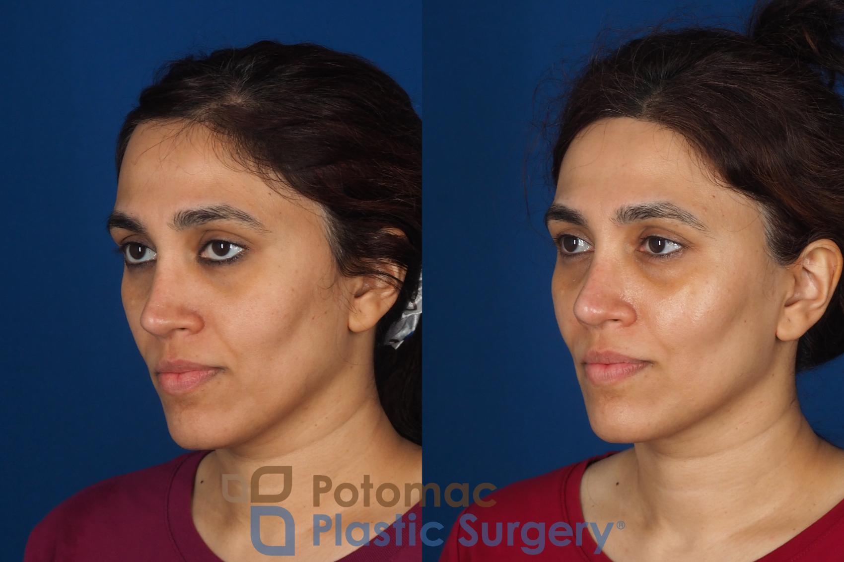 Before & After Fat Transfer Case 358 Left Oblique View in Washington DC & Arlington , DC