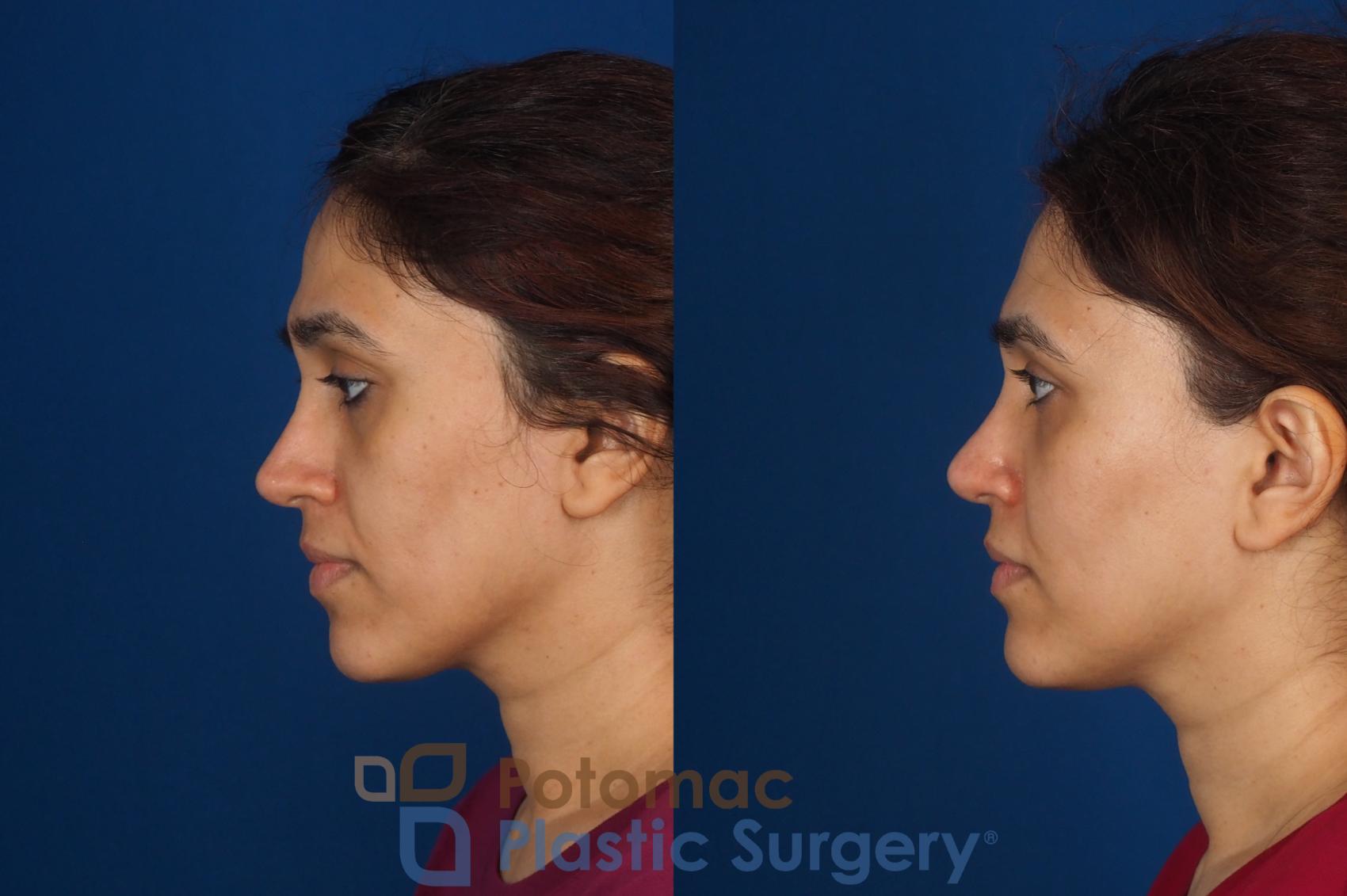 Before & After Fat Transfer Case 358 Left Side View in Washington DC & Arlington , DC