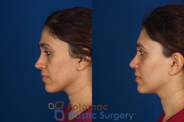 Before & After Fat Transfer Case 358 Left Side View in Washington DC & Arlington , DC