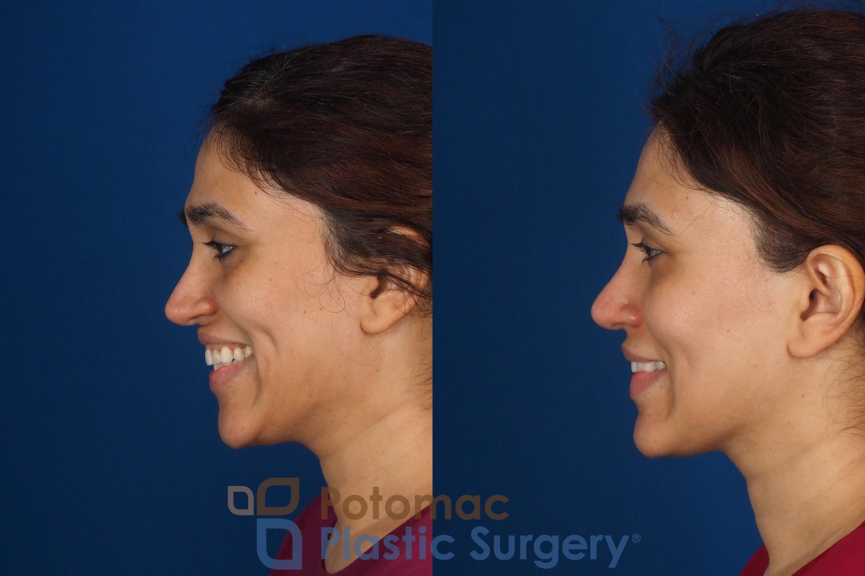 Before & After Fat Transfer Case 358 Left - Smiling View in Washington DC & Arlington , DC