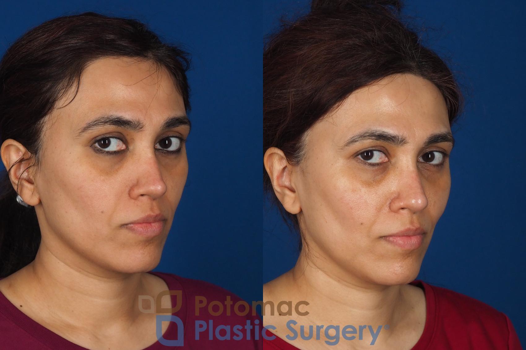 Before & After Fat Transfer Case 358 Right Oblique 2 View in Washington DC & Arlington , DC