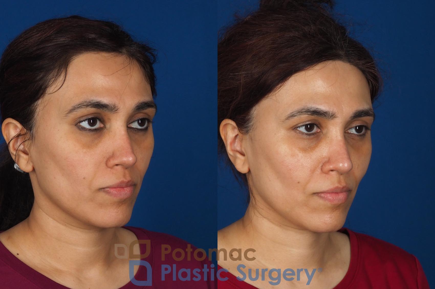 Before & After Fat Transfer Case 358 Right Oblique View in Washington DC & Arlington , DC