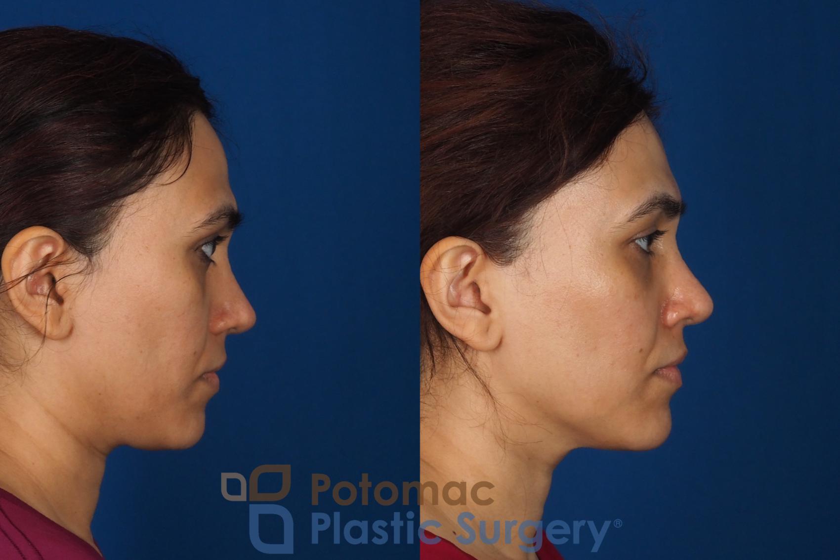 Before & After Fat Transfer Case 358 Right Side View in Washington DC & Arlington , DC