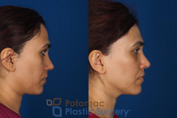 Before & After Fat Transfer Case 358 Right Side View in Washington DC & Arlington , DC