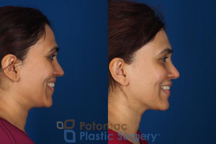 Before & After Fat Transfer Case 358 Right - Smiling View in Washington DC & Arlington , DC