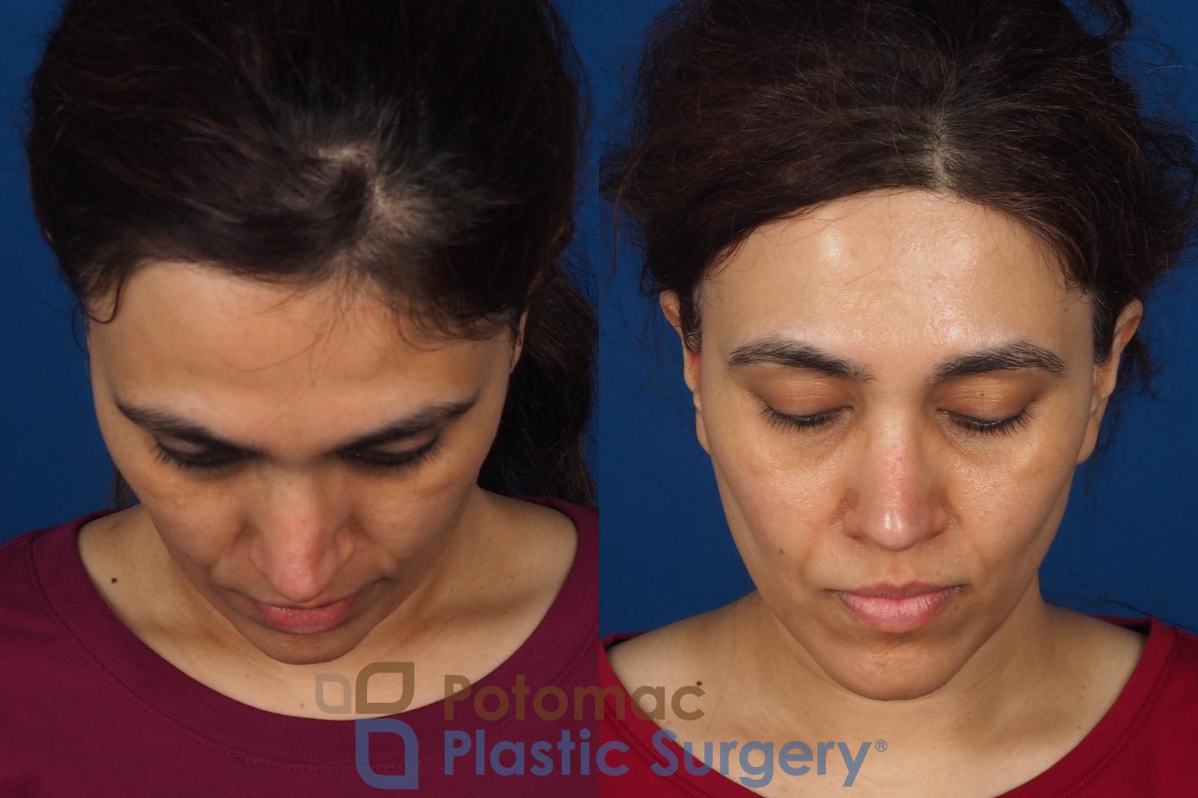 Before & After Fat Transfer Case 358 Top View in Washington DC & Arlington , DC