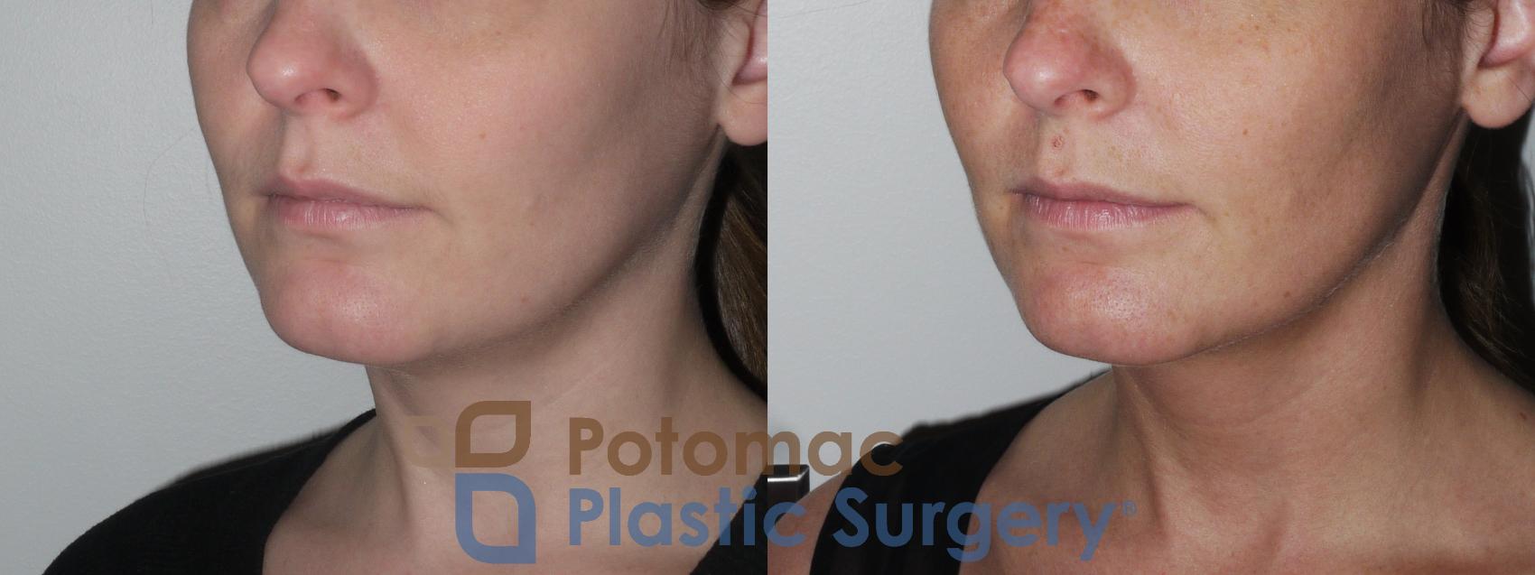 Before & After Kybella Case 151 Left Oblique View in Washington DC & Arlington , DC