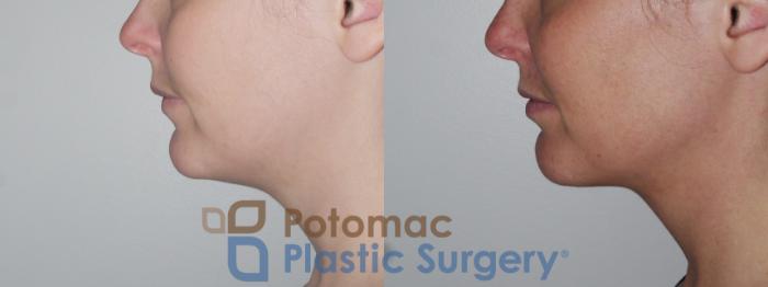 Before & After Kybella Case 151 Left Side View in Washington DC & Arlington , DC