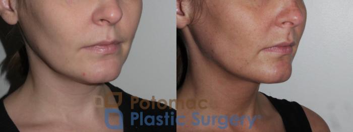 Before & After Kybella Case 151 Right Oblique View in Washington DC & Arlington , DC