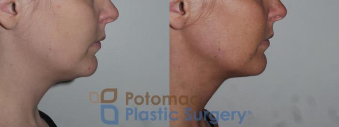 Before & After Facial Sculpting Case 151 Right Side View in Washington DC & Arlington , DC