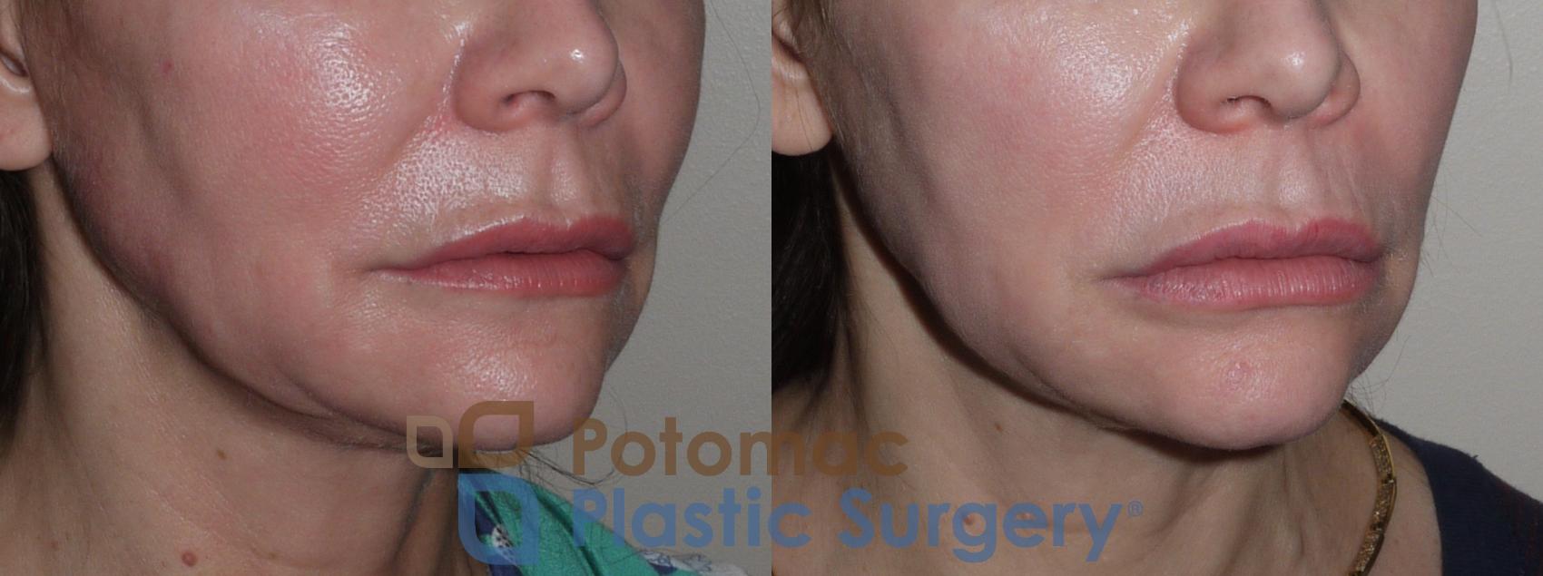 Before & After Lip Augmentation Case 124 Right Oblique View in Washington, DC