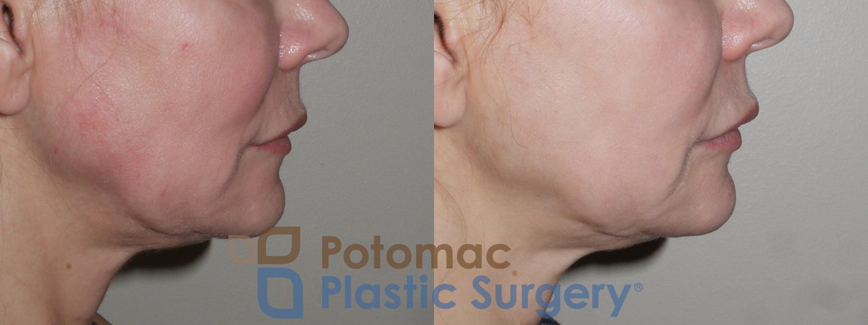 Before & After Lip Augmentation Case 124 Right Side View in Washington, DC