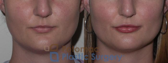 Before & After Dermal Fillers Case 126 Front View in Washington DC & Arlington , DC