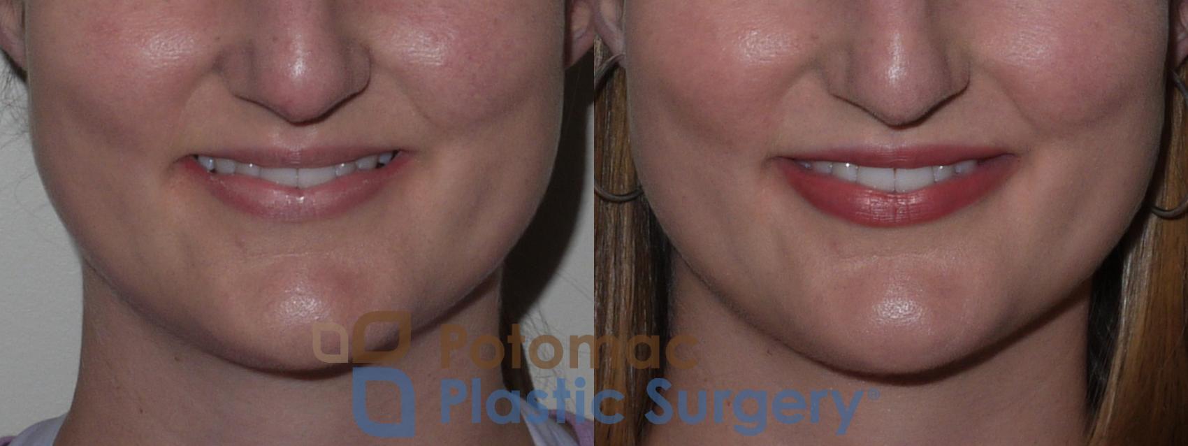 Before & After Lip Augmentation Case 126 Front View #2 View in Washington DC & Arlington , DC