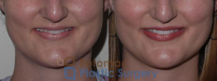 Before & After Lip Augmentation Case 126 Front View #2 View in Washington DC & Arlington , DC