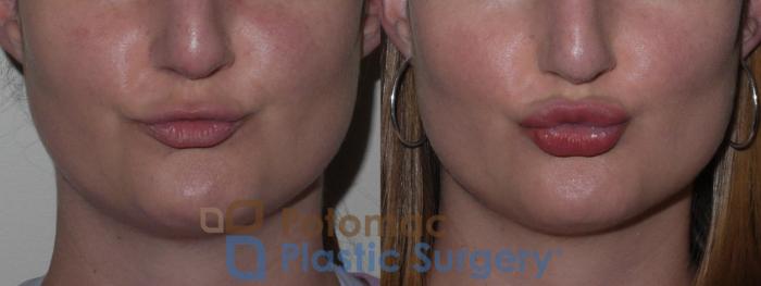 Before & After Lip Augmentation Case 126 Front View #3 View in Washington DC & Arlington , DC