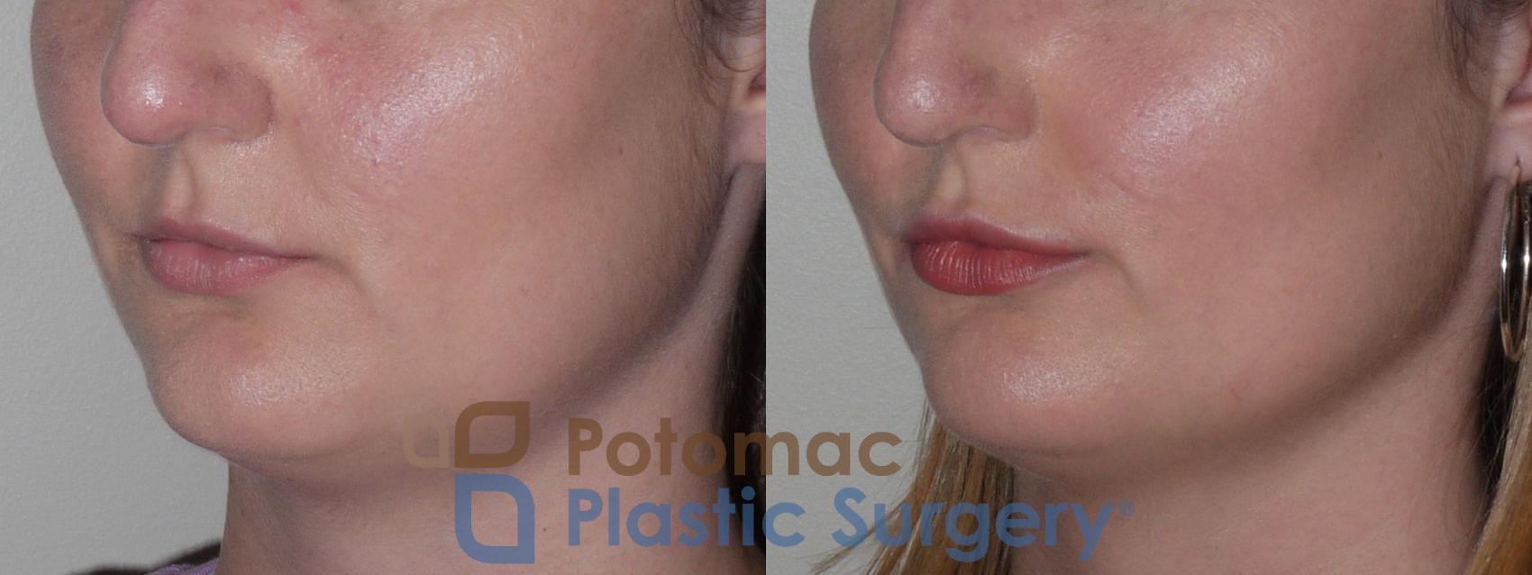 Before & After Lip Augmentation Case 126 Left Oblique View in Washington DC & Arlington , DC