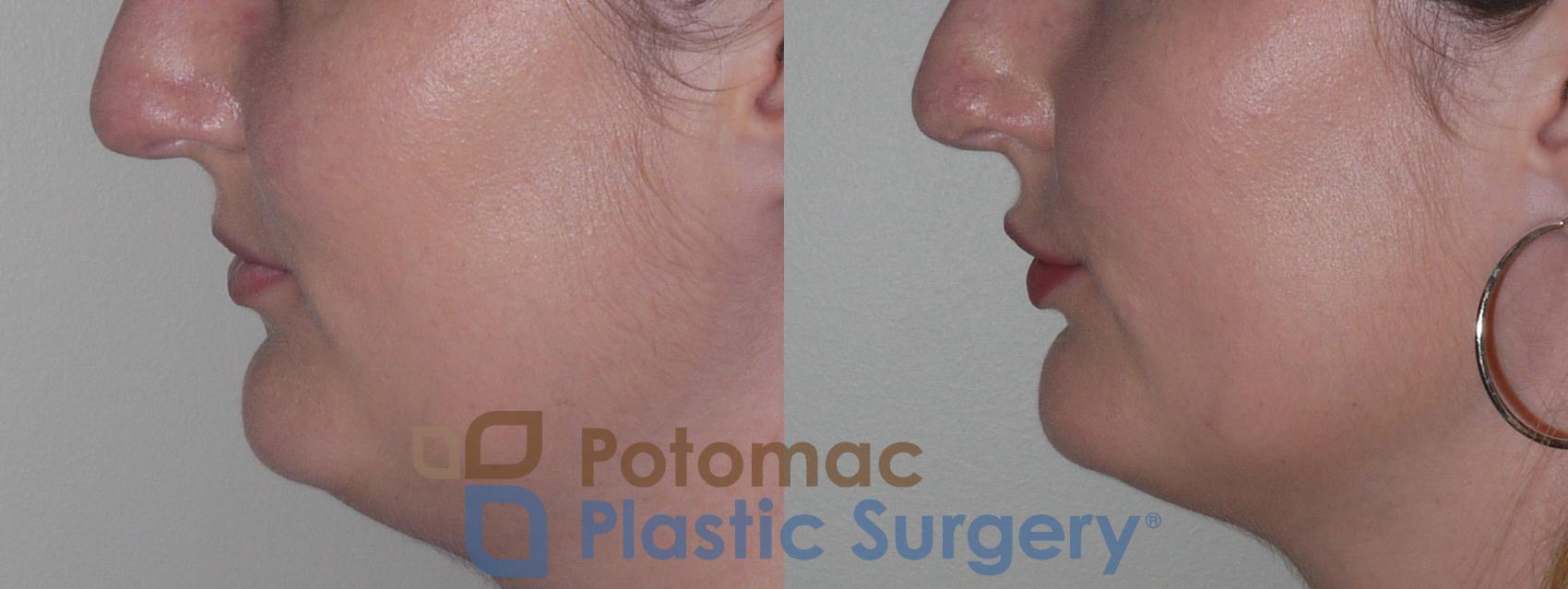 Before & After Lip Augmentation Case 126 Left Side View in Washington DC & Arlington , DC