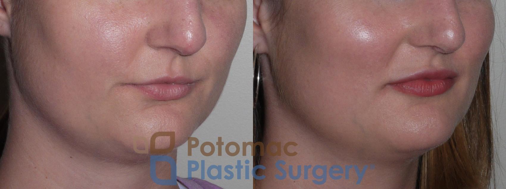 Before & After Lip Augmentation Case 126 Right Oblique View in Washington DC & Arlington , DC