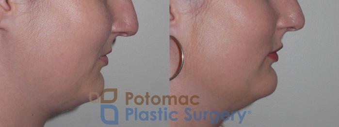 Before & After Dermal Fillers Case 126 Right Side View in Washington DC & Arlington , DC