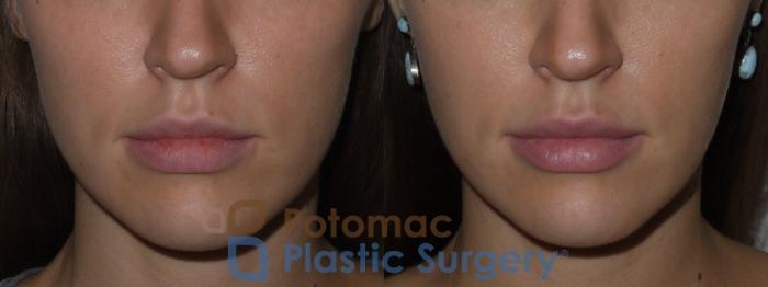 Before & After Dermal Fillers Case 127 Front View in Washington DC & Arlington , DC