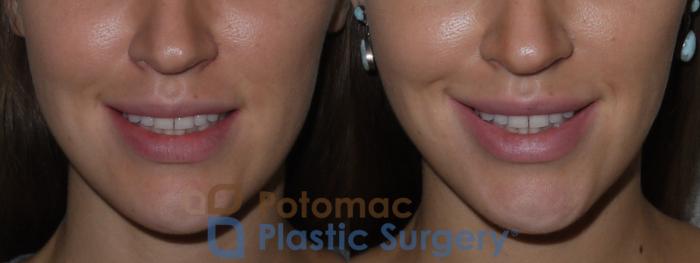 Before & After Lip Augmentation Case 127 Front View #2 View in Washington DC & Arlington , DC