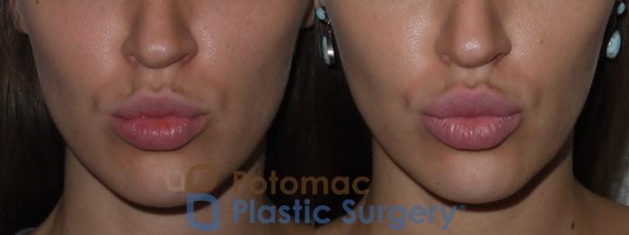 Before & After Lip Augmentation Case 127 Front View #3 View in Washington DC & Arlington , DC