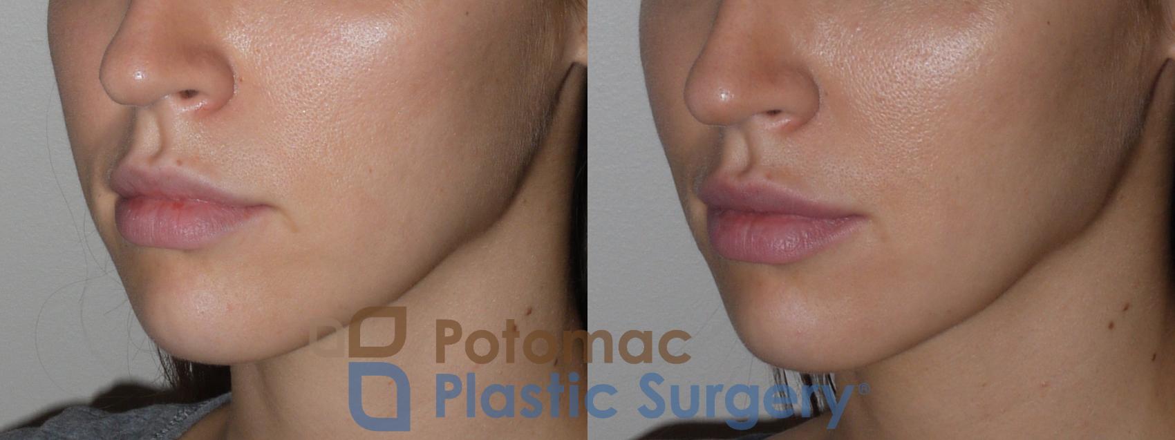 Before & After Lip Augmentation Case 127 Left Oblique View in Washington DC & Arlington , DC