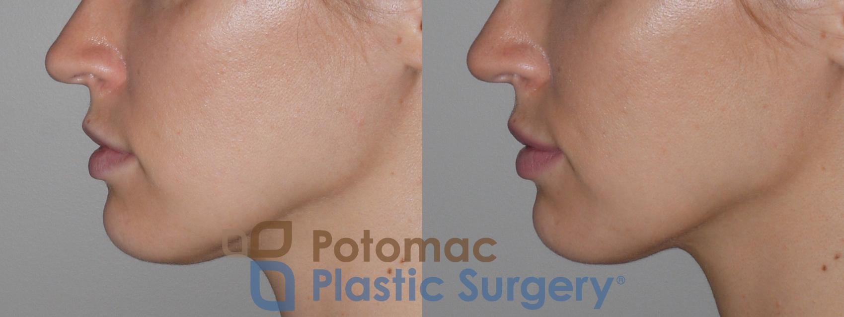 Before & After Lip Augmentation Case 127 Left Side View in Washington DC & Arlington , DC