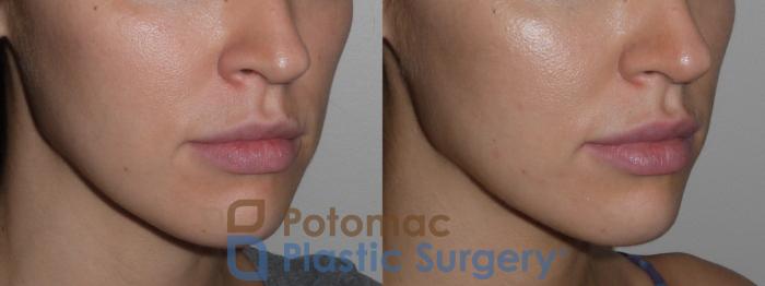 Before & After Lip Augmentation Case 127 Right Oblique View in Washington DC & Arlington , DC