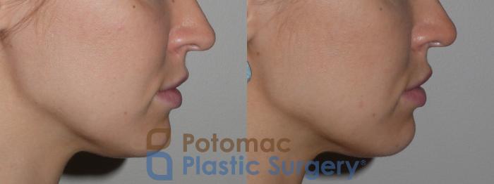 Before & After Dermal Fillers Case 127 Right Side View in Washington DC & Arlington , DC