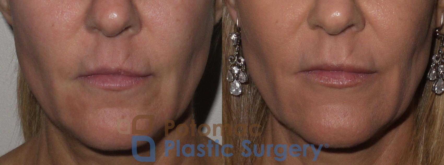 Before & After Dermal Fillers Case 129 Front View in Washington DC & Arlington , DC