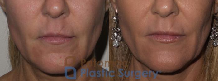 Before & After Dermal Fillers Case 129 Front View in Washington DC & Arlington , DC