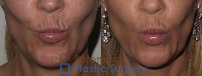 Before & After Lip Augmentation Case 129 Front View #2 View in Washington DC & Arlington , DC