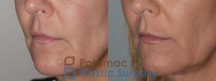 Before & After Lip Augmentation Case 129 Left Oblique View in Washington DC & Arlington , DC