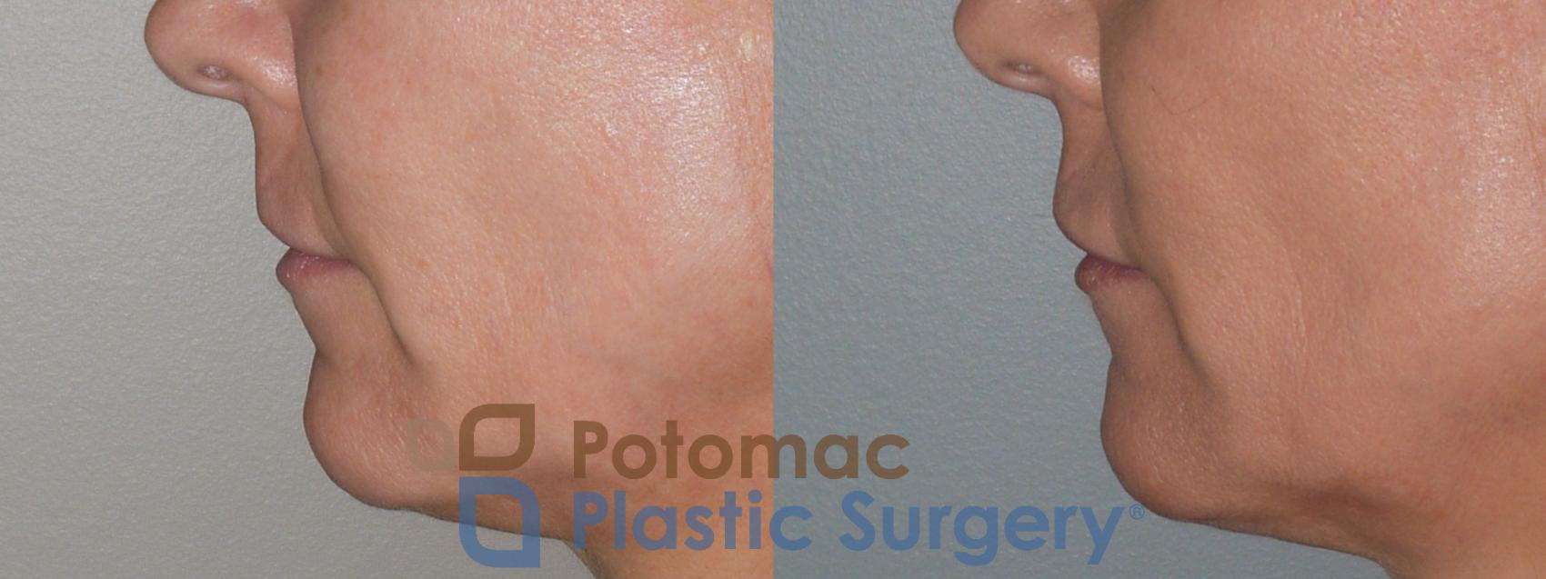 Before & After Lip Augmentation Case 129 Left Side View in Washington DC & Arlington , DC