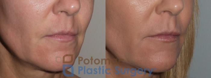 Before & After Lip Augmentation Case 129 Right Oblique View in Washington DC & Arlington , DC