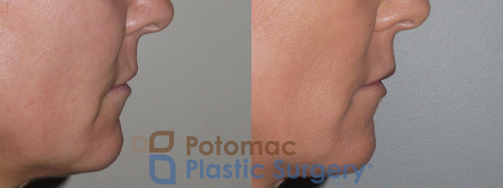 Before & After Lip Augmentation Case 129 Right Side View in Washington DC & Arlington , DC