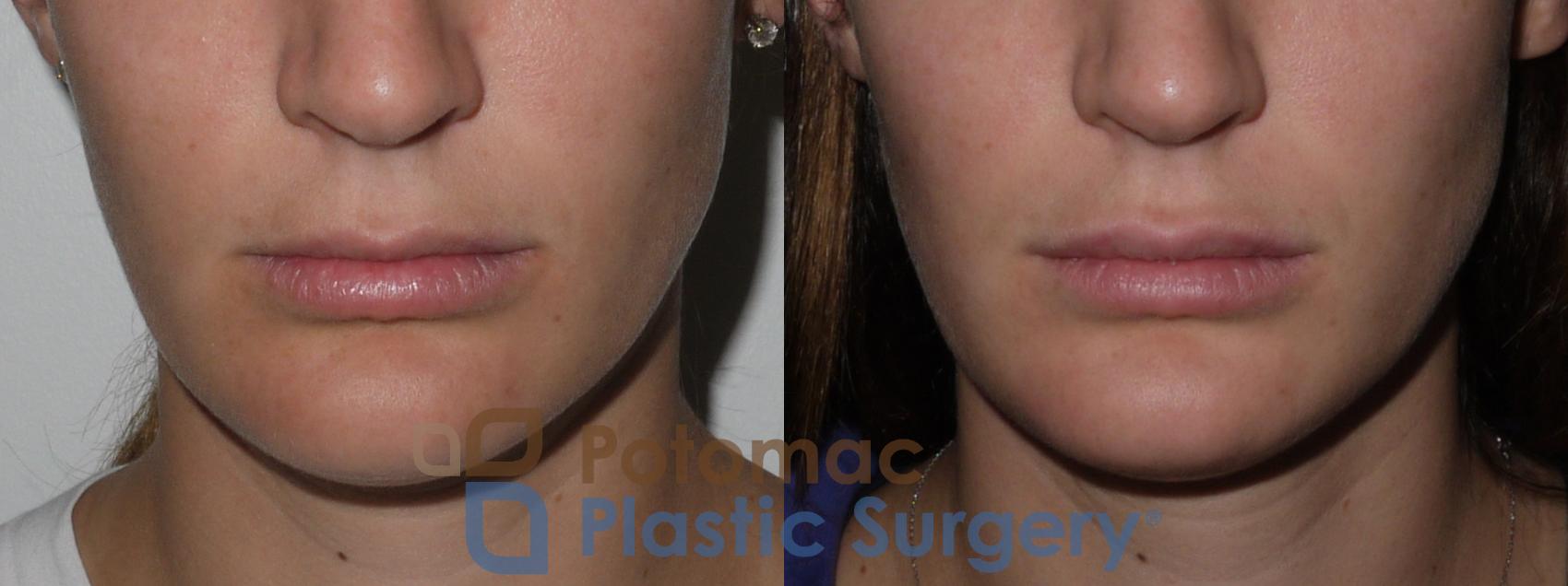 Before & After Dermal Fillers Case 142 Front View #1 View in Washington DC & Arlington , DC