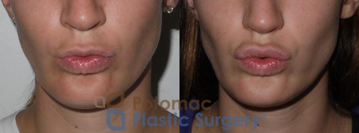Before & After Lip Augmentation Case 142 Front View Pucker View in Washington, DC