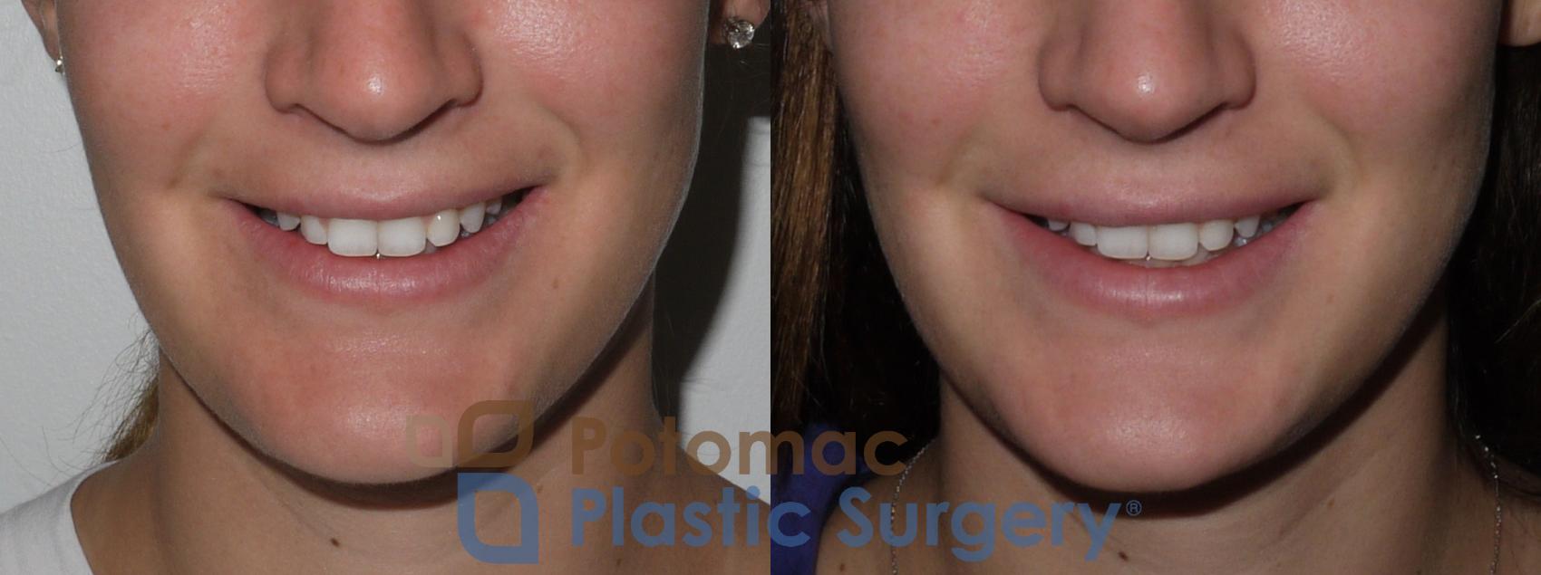 Before & After Lip Augmentation Case 142 Front View Smile View in Washington, DC