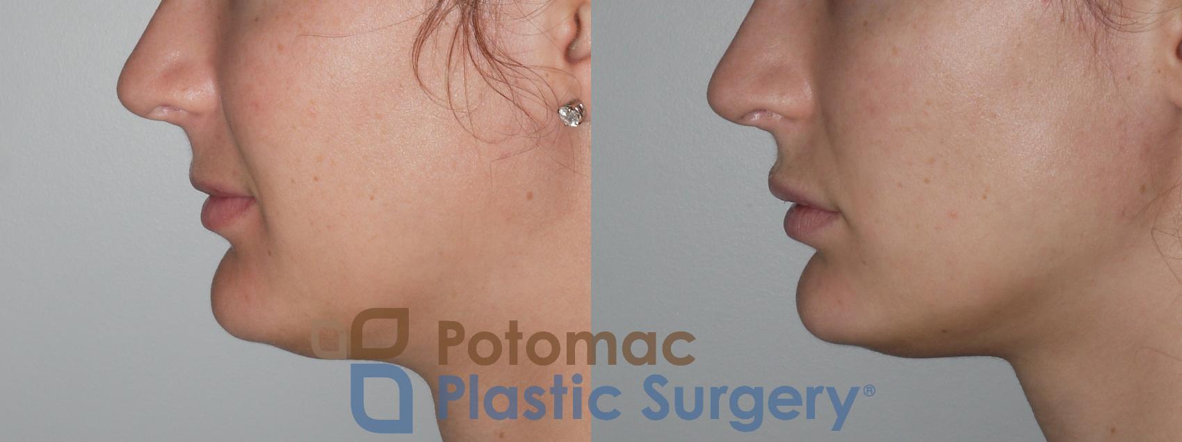Before & After Lip Augmentation Case 142 Left Side View in Washington, DC